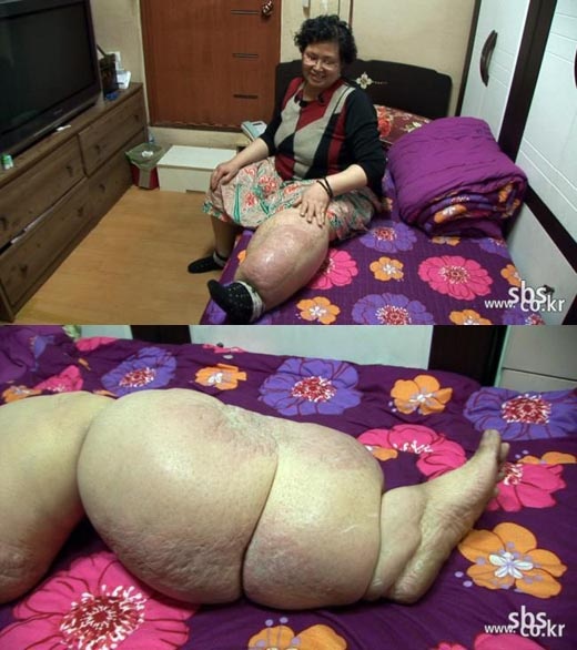 세상에 이런일이, 암 수술 후 코끼리다리 가진 아줌마 사연 화제