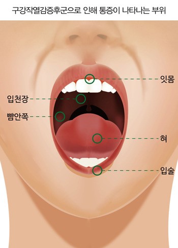 입안 화끈거리고, 혀가 아프다? 꾀병 아닌 구강작열감증후군