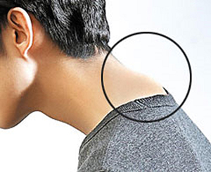 목 뒤에 혹처럼 불룩… ‘버섯증후군’ 아세요?