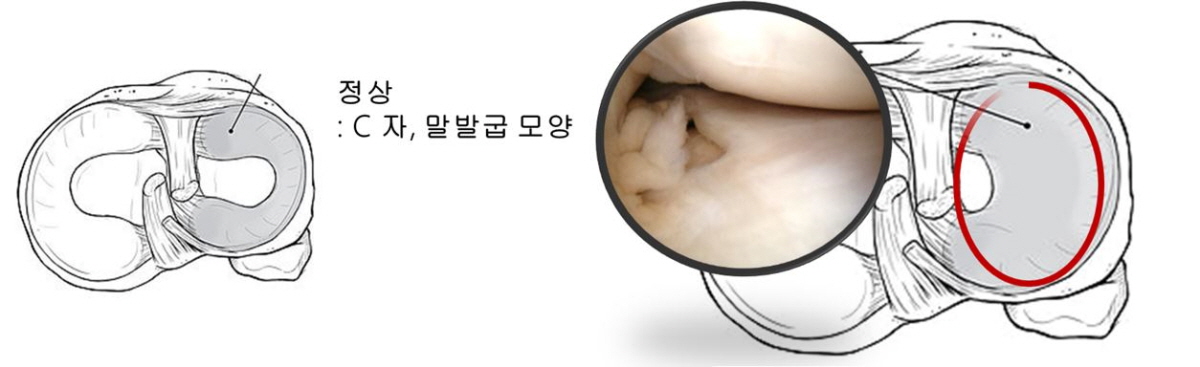 운동하다 다친 무릎, 반월 연골판 바로 확인을… 관절염 진행 위험