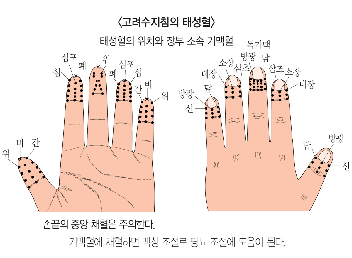 고려수지침학회 손 끝에 있는 태성혈 자리에서 채혈하세요