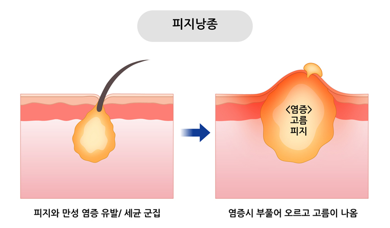 없애자니 귀찮고 놔두자니 거슬리는 피지낭종·지방종,  해결법은? [정의철 원장이 들려주는 알기쉬운 미용의학 이야기]