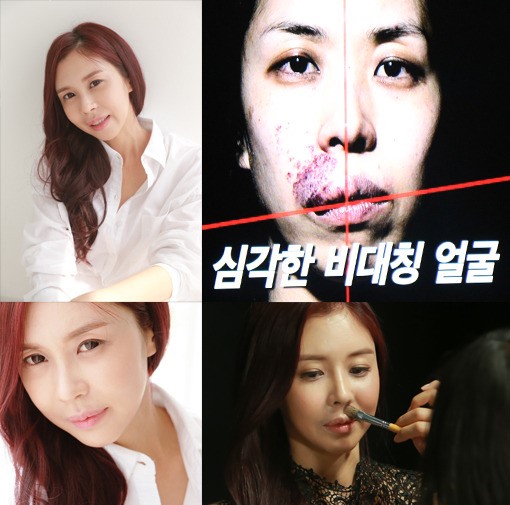 렛미인4 김희은, 무너진 반쪽 얼굴 탈출…화염상 모반치료 등 천만원 이상