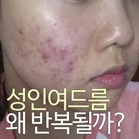 성인여드름, 한의원에서는 어떻게 치료할까?