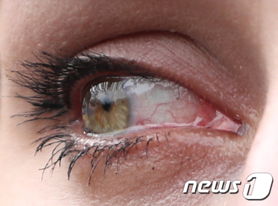 우크라이나의 붉어진 눈시울
