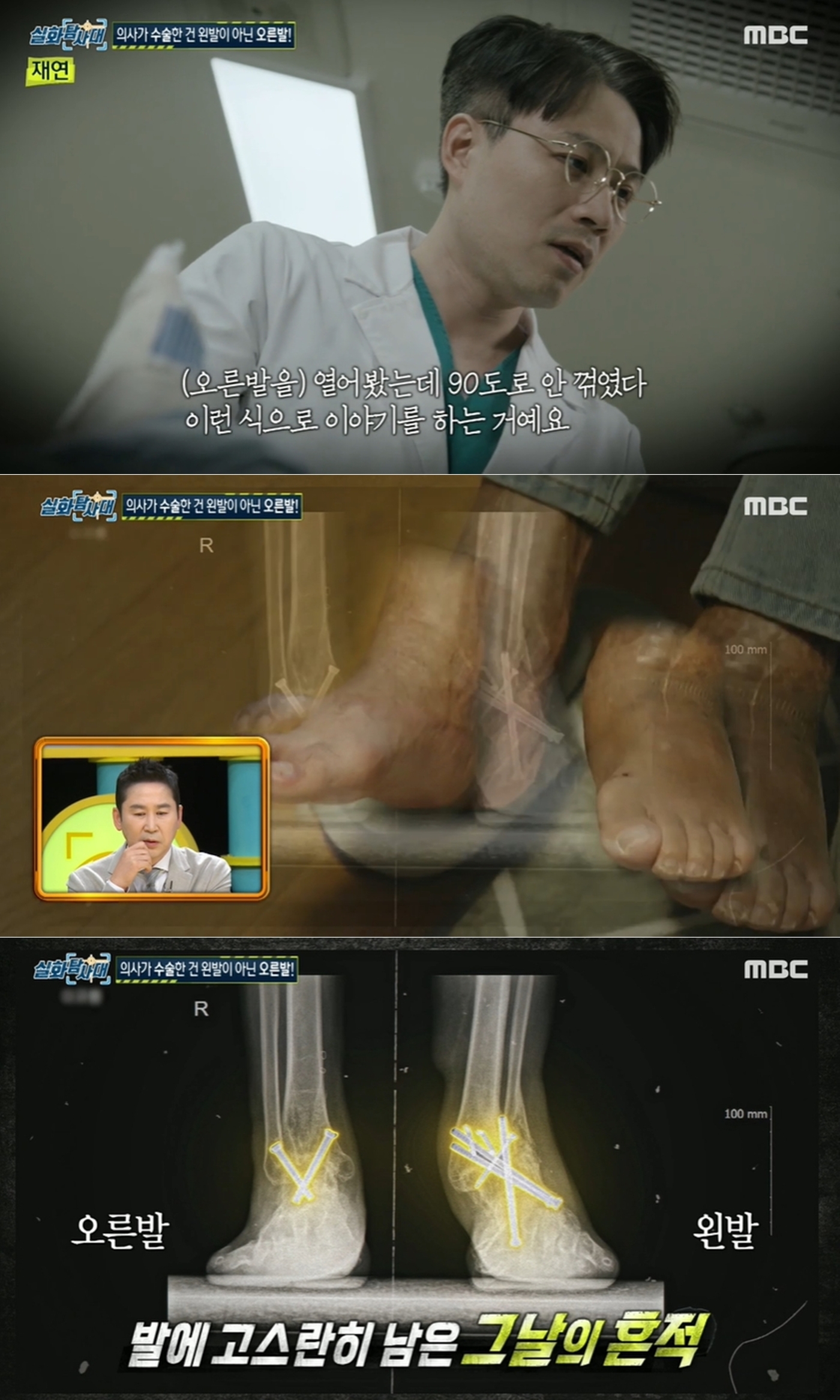 아픈 왼발 아닌 멀쩡한 오른발 뼈 자른 유명 병원…언론에 알리면 서로 곤란