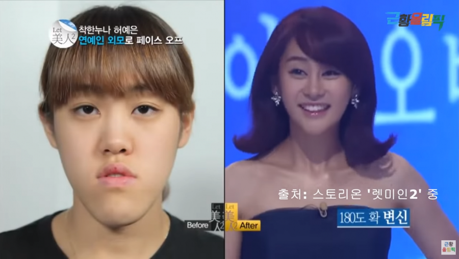 렛미인2 주걱턱녀 허예은, 성형 8년후 근황…인생이 크게 바뀌었다[종합]