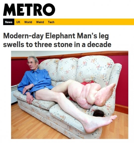 [포토] 한쪽 다리가 코끼리 다리처럼 된 男