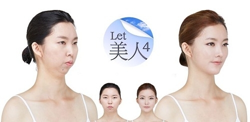 양악수술, ‘렛미인’ 16인 V라인 비결로 밝혀져