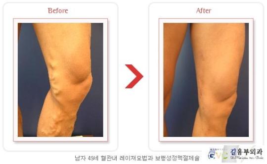혈액의 역류가 일어나서 늘어난 혈관이 보이는 하지정맥류 예방법은?