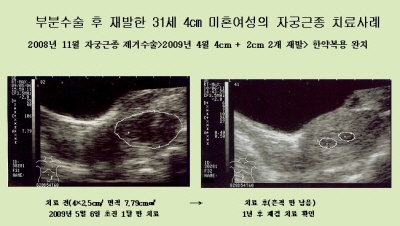 여성건강 위협하는 자궁근종, 한약으로 잡아준다