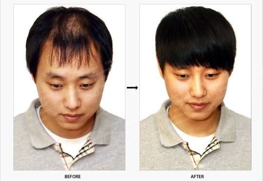 크레이지드레드(CrazyDread) 세계상 대표 탈모 스트레스를 붙임머리, 증모로 날려버리세요