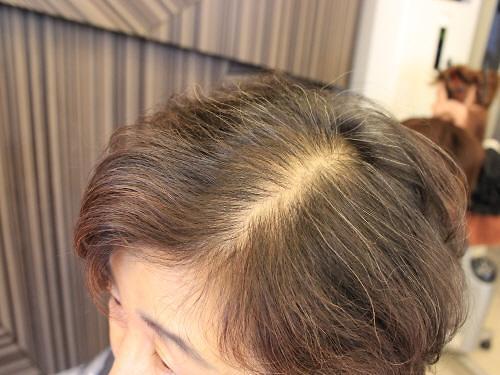 탈모에 대한 고민, 여성부분가발 대신 앞머리증모술로 해결하세요