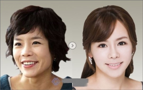 신이 양악수술 후 3년간 슬럼프 수술 전후 비교해 보니…