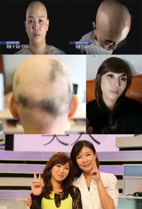 렛미인 괴물엄마, 민머리에서 주사치료로 머리카락이 자랐다?
