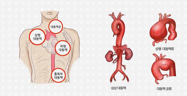 상행대동맥 늘어나는 대동맥류 파열확률 3% 미만
