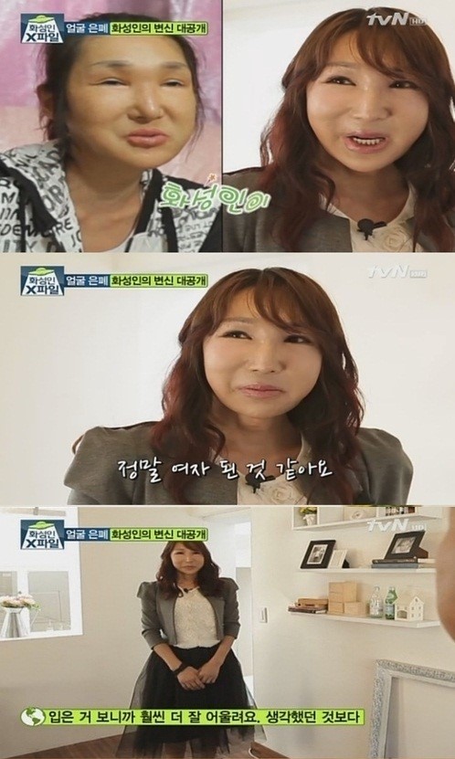 화성인 얼굴은폐녀 수술 후, 10년 젊어진 외모 ‘깜짝’