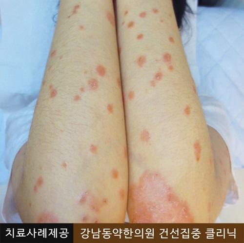 새해에는 건선 탈출? 건선치료방법 A to Z