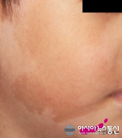 난치성 갈색반점, 밀크커피반점(카페오레반점) 완치 가능할까?