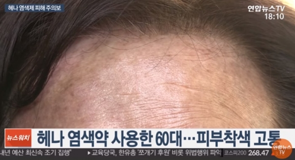 어쩌다 이런일이? 헤나 염색 부작용, 검게 변한 피부… 원상태로 못 돌아가