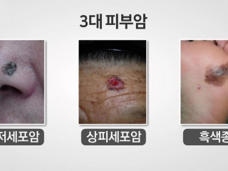 [내 몸 보고서] 내 몸의 반점, 점일까? 암일까?…피부암의 모든 것