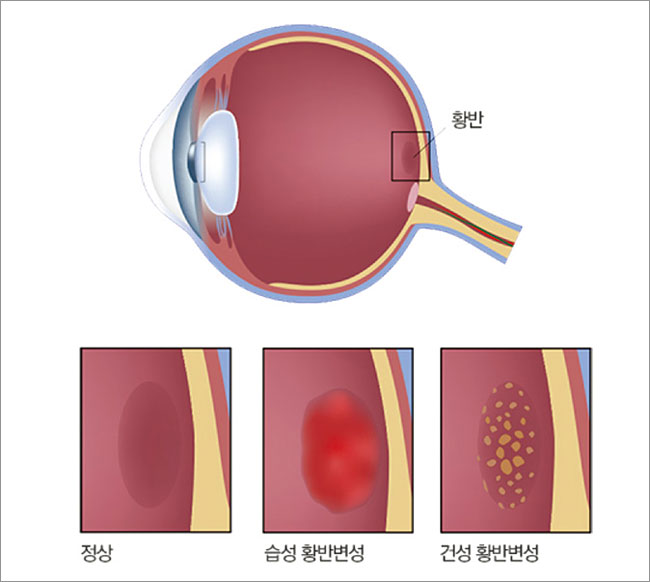 [CEO건강학 ] 눈에 아지랑이 아른아른 황반변성…안과 검진 중요