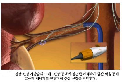 신장신경차단술, 난치성 고혈압에 효과 없다?