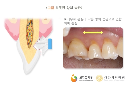충치 아닌데도 이가 시린 ‘상아질 지각과민증’