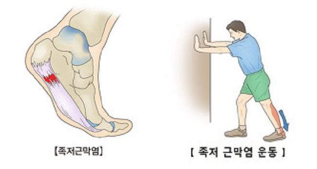 족저근막염, 최근 5년간 2배 증가
