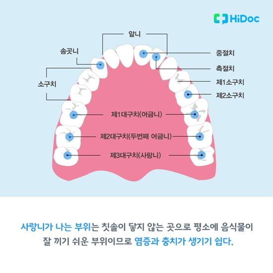 사랑니, 꼭 뽑아야 하나요?