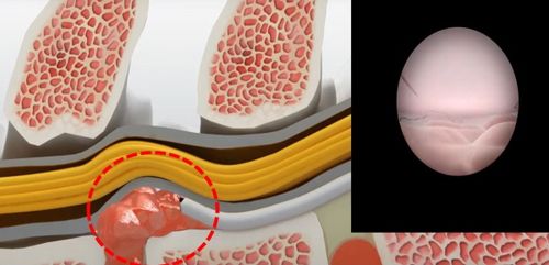 만성 허리통증 디스크 수술적 제거 대신 레이저 시술로 형태 복원