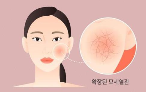 [공감신문 알쓸다정] 양 볼을 빨갛게 물들이는 안면홍조 없애는 법