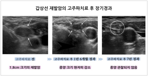 갑상선암 재발에 고주파치료…5년 지나도 재발ㆍ부작용 ↓