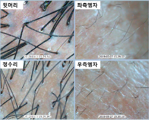 이마가 자꾸 넓어져서 고민이라면? M자탈모 자가진단 방법 숙지해야