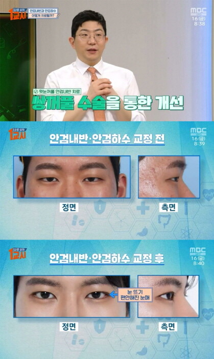 땡큐성형외과 김형석 원장, MBC ‘나를 살리는 1교시’서 기능눈성형 강연