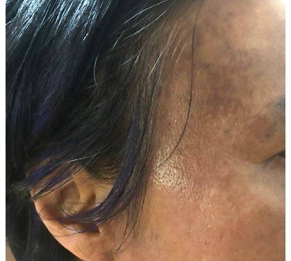 대인기피증에 우울증까지...끔찍한 헤나 염색 부작용
