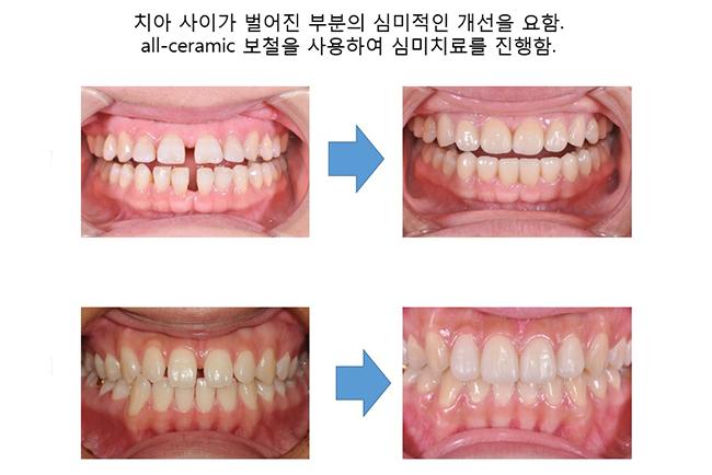 우린 예뻐지려고 치과 간다!