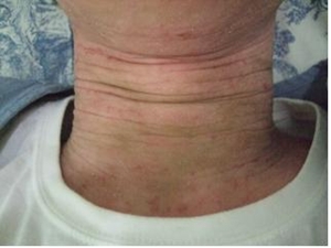 [윤영희 칼럼]아토피피부염 진료지침에 따른 한약제제의 활용(하)