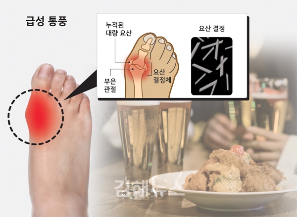 바람만 스쳐도 아픈 통풍… 치맥·곱창 피하라