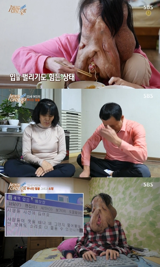 신경섬유종女 130cm-30kg, 수술하고파 세상에이런일이이 바꾼 세상