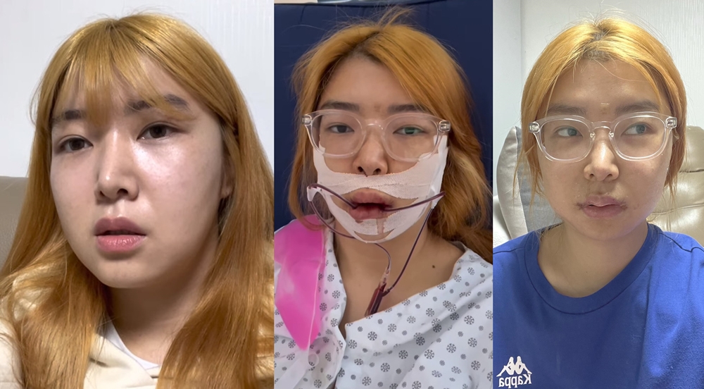 우물 안 개구리였다…나는 솔로 10기 영자, 미용실 퇴사→양악·광대·턱 끝 성형수술 이유 [TOP이슈]