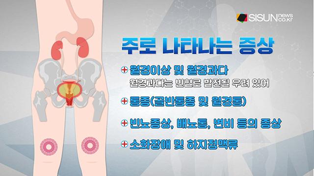 자궁근종, 가임기 여성이 필수로 알아야 하는 이유 [건강프라임-시선뉴스]