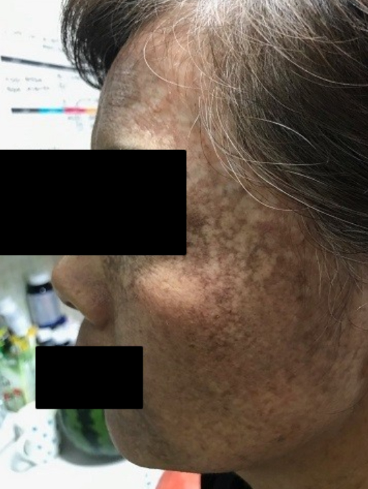 또 터진 ‘헤나 염색약’ 부작용 의혹…“뿌리염색 후 피부 계속 검어져”