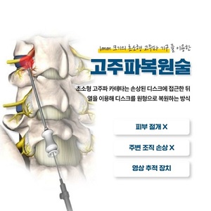 허리디스크 치료, 고주파복원술 통해 개선 도움
