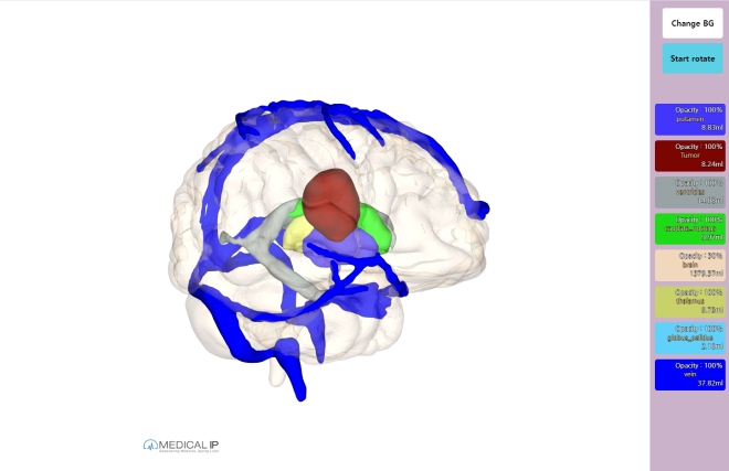 메디컬아이피, 3D프린팅한 뇌종양 모델 임상 효과에 대한 검증 받아