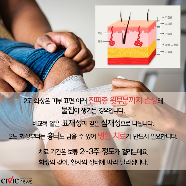 [카드뉴스] 응급처치, 심재성, 치료, 흉터… 화상에 대한 지식 알아보기