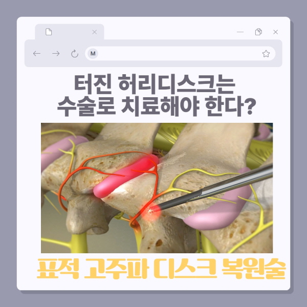 허리디스크 터지면 수술? 표적고주파 시술로 복원치료