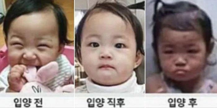 16개월이 갈비뼈 부러진다? 교과서에 실릴 정도의 아동학대···의사가 본 정인이 사건