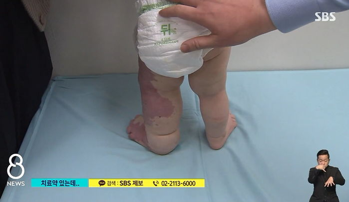 13개월 호빈이의 코끼리 다리, 약 무료로 받을 수 있는데도 치료 못 받고 있습니다