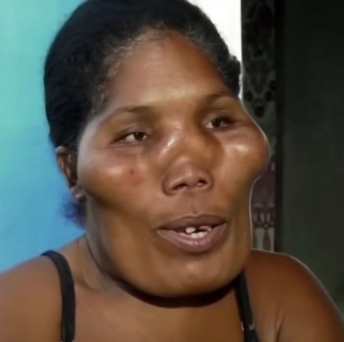 전 세계에 단 40명...얼굴뼈 변형되는 E.T 병 걸린 5남매의 가슴 아픈 사연 (영상)